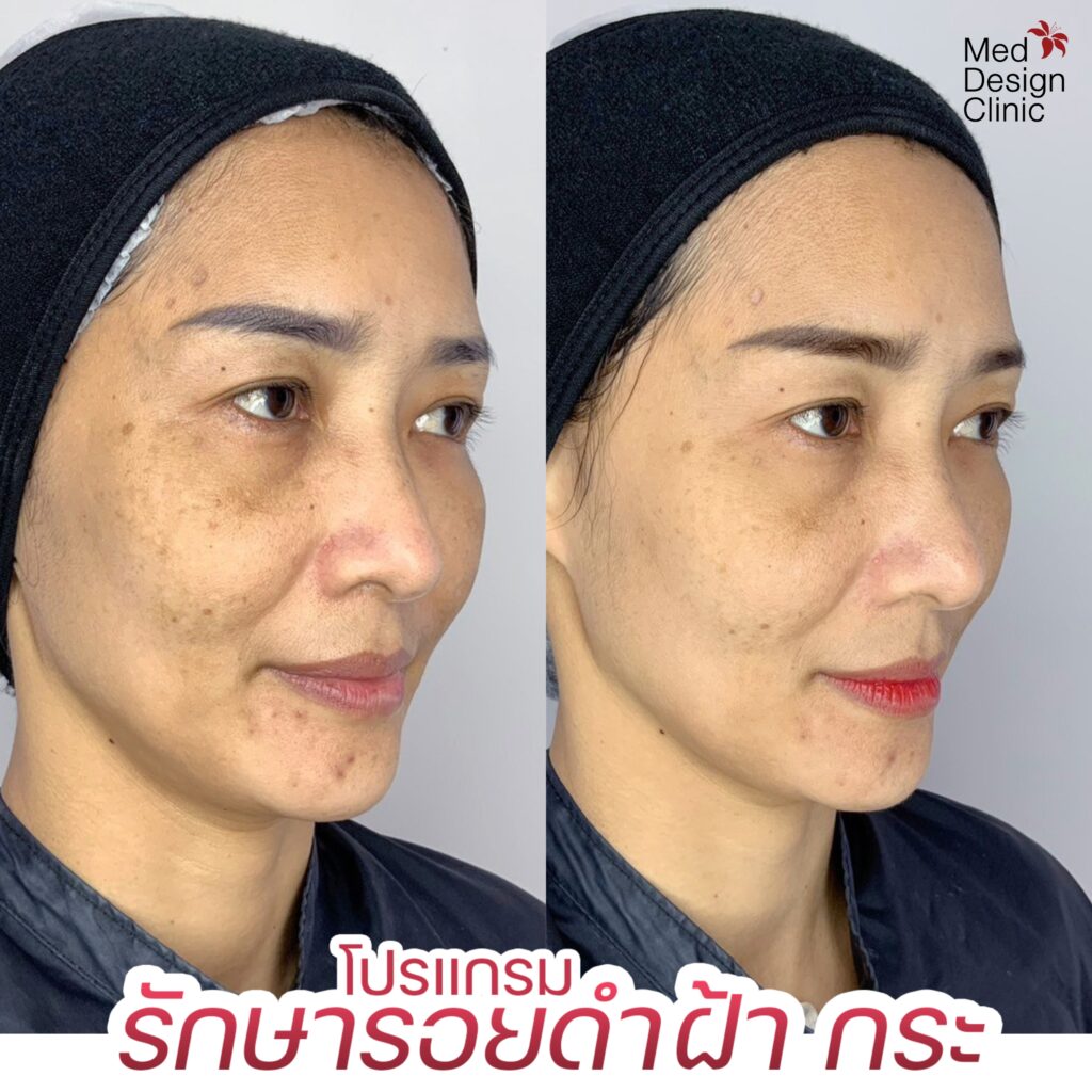 รักษากระ