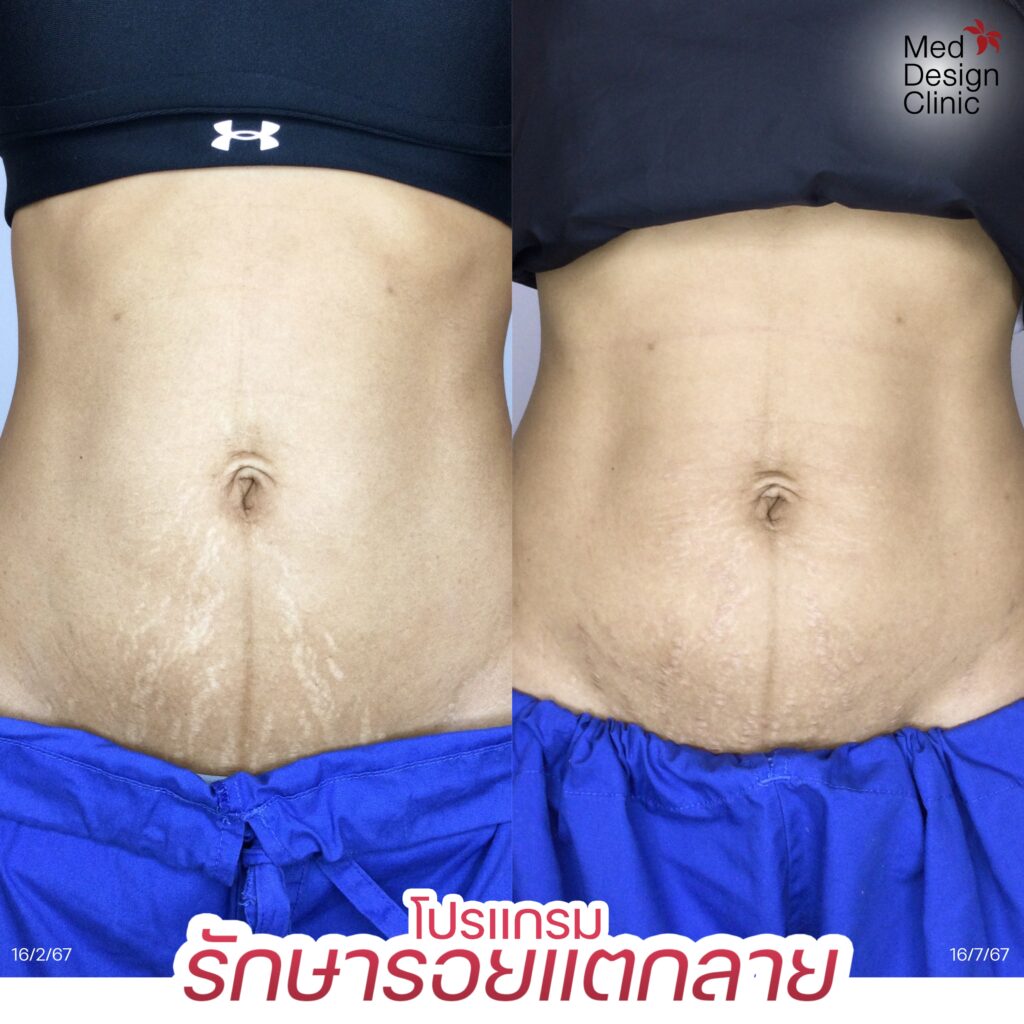 รอยแตกลาย Juvelook
