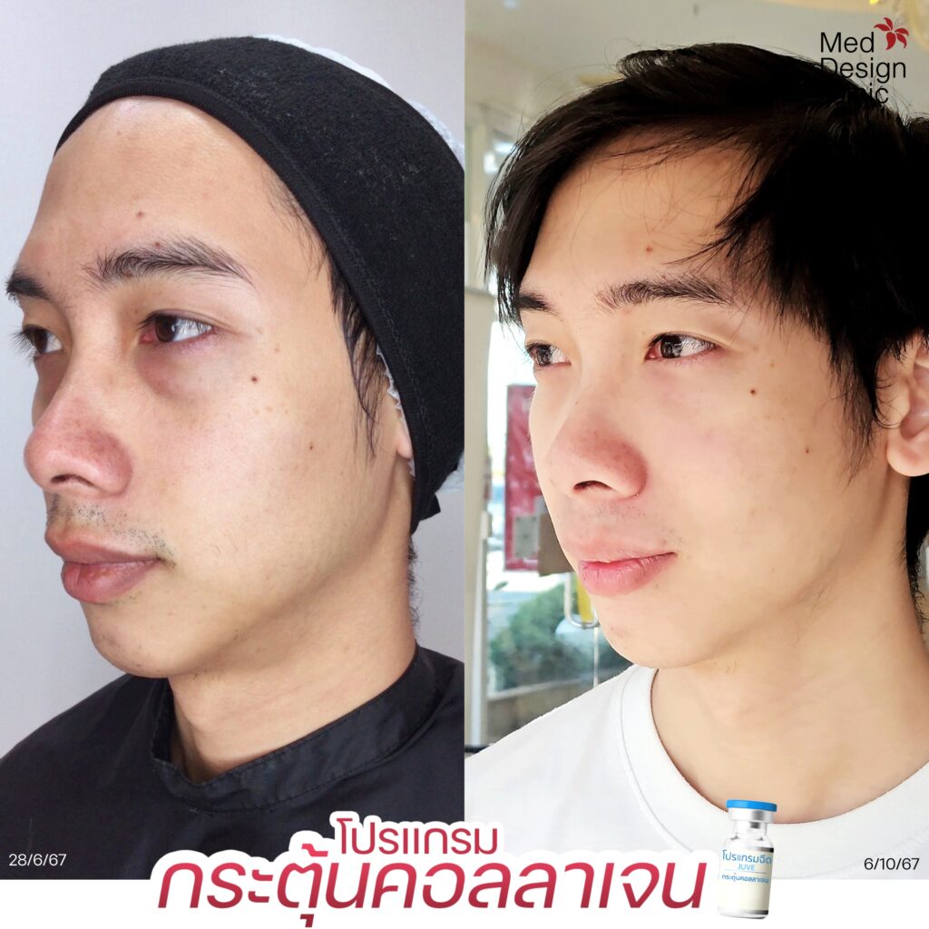 Juvelook ใต้ตา