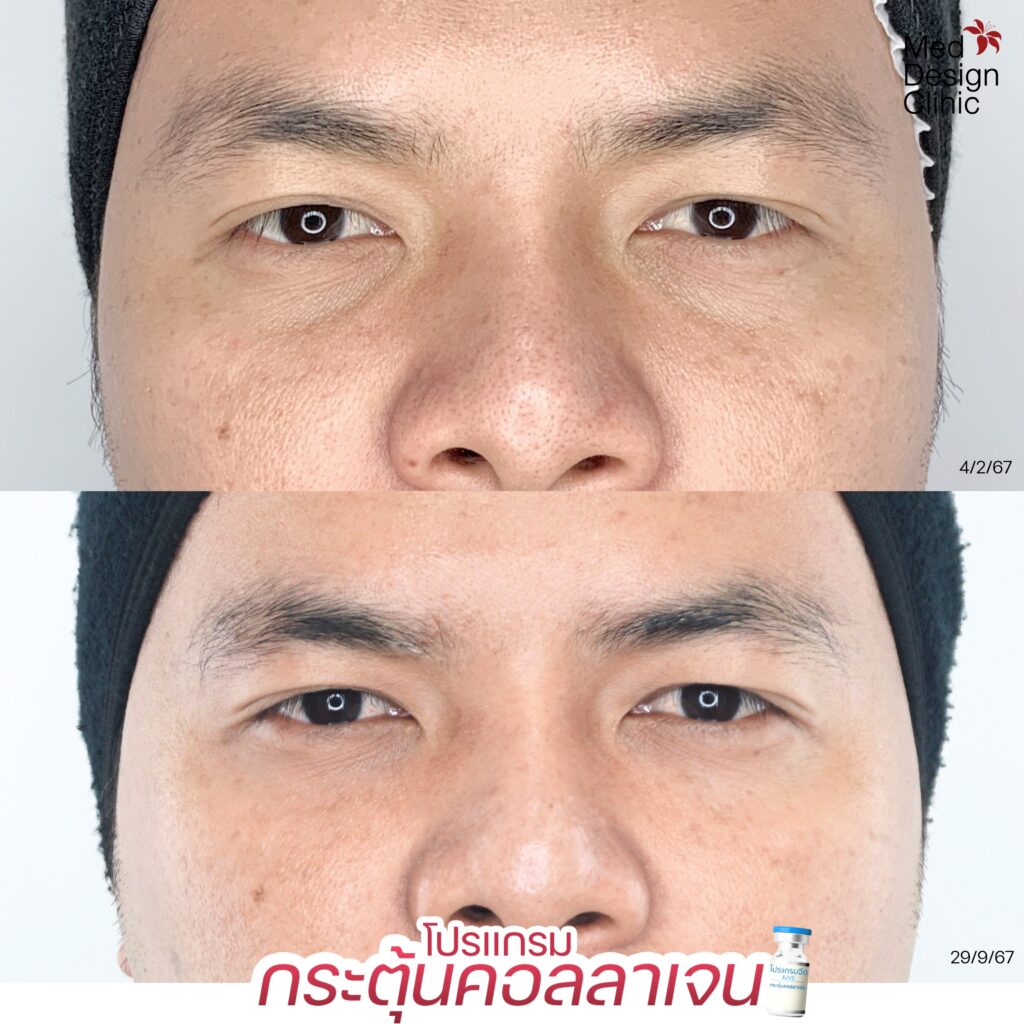 Juvelook ใต้ตา