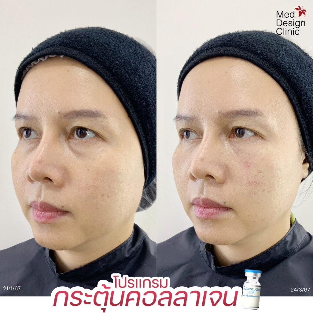 Juvelook เติมร่องใต้ตา